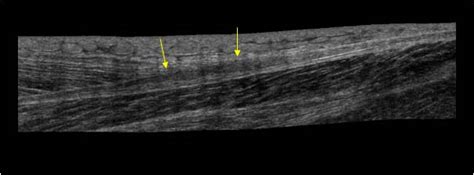 Musculoskeletal, bone, muscle, nerves and other soft tissues | 7.2 Muscle : Case 7.2.6 Plantaris ...