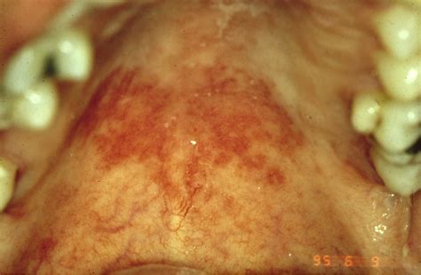 Erythematous candidiasis