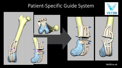 Arthrex - OrthoLine™ Distal Femur Osteotomy System