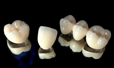 What is a PFM dental crown? | News | Dentagama