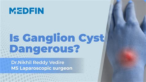 Ganglion Cyst: Causes, Diagnosis & Treatment - YouTube