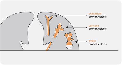 Definition - Bronchiectasis