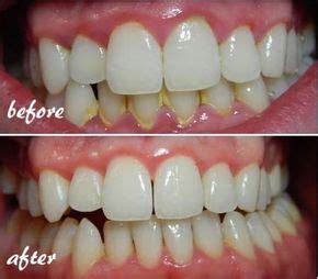 How To Remove Dental Plaque From Your Teeth Naturally