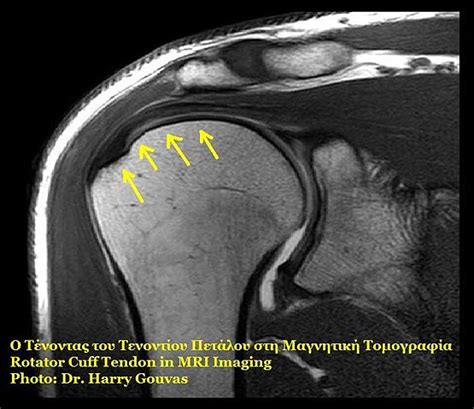 Rotator Cuff Tear — Surgical Treatment | Online Medical Library