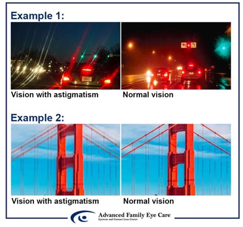 Astigmatism Q&A - Symptoms, Causes, Treatment