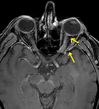 Optic Neuritis-MRI - Sumer's Radiology Blog