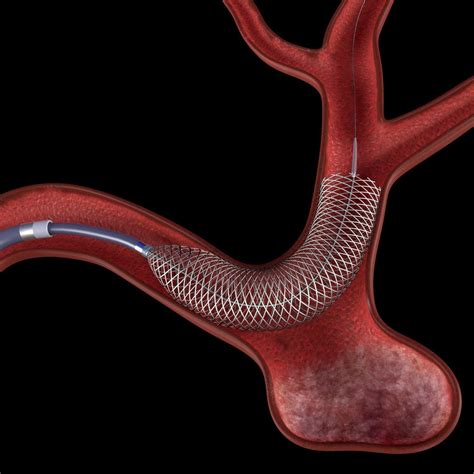 Flow diverter stent in aneurysm 3D model | CGTrader