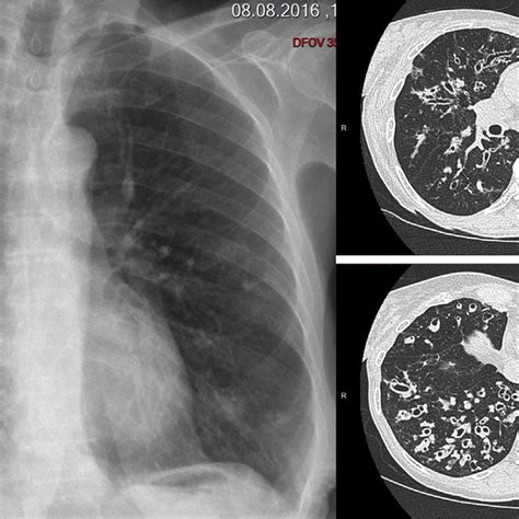 Bronchiectasis Chest X Ray