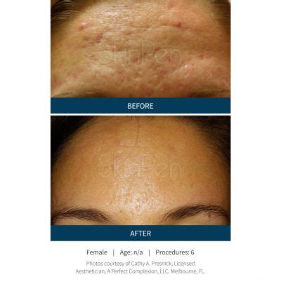 Treating Acne Scars | Microneedling & More | Columbia, MO