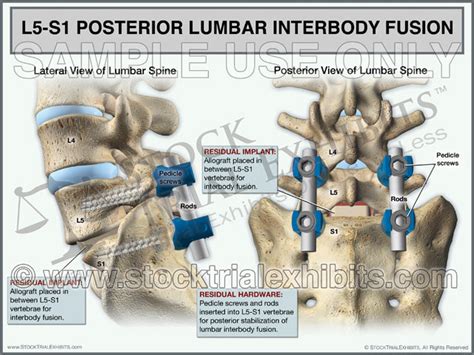 L5-S1 Posterior Lumbar Interbody Fusion (PLIF) – Stock Trial Exhibits