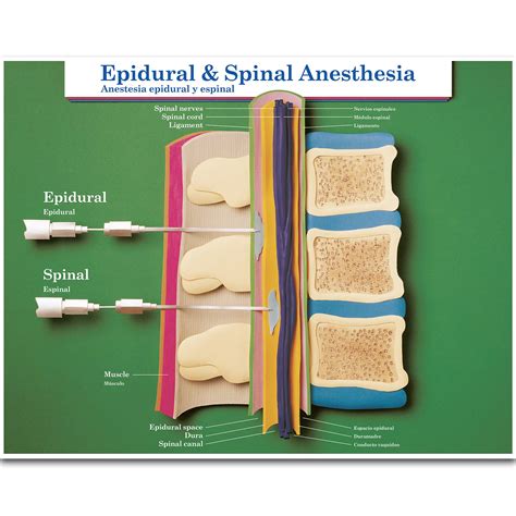 Buy Epidural & Spinal Anesthesia Chart Online at desertcartSri Lanka