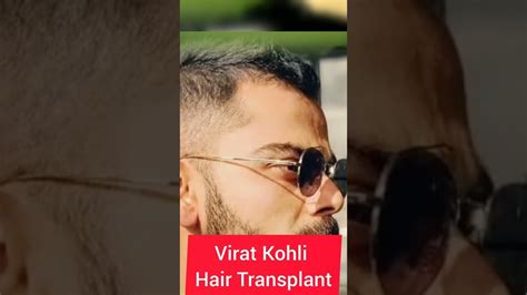 Virat Kohli Hair Transplant | Celebrity Hair Transplant | Indian ...