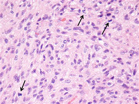 Astrocytoma IDH mutant CNS WHO grade 3 | MyPathologyReport.ca