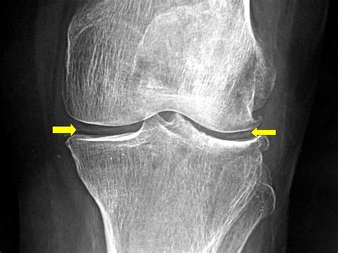 Chondrocalcinosis [pseudogout] - radRounds Radiology Network