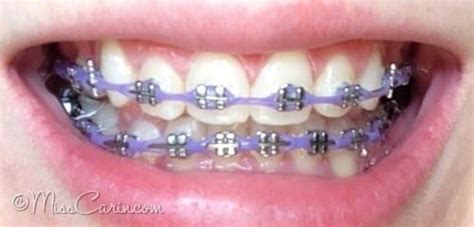 lilac/ lavender braces: power chain | Braces | Cute braces colors, Teeth braces, Braces smile