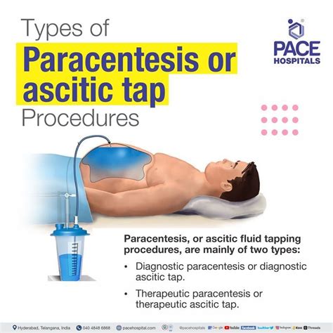 Paracentesis, Ascites Tapping in Hyderabad, India - Indication & Cost