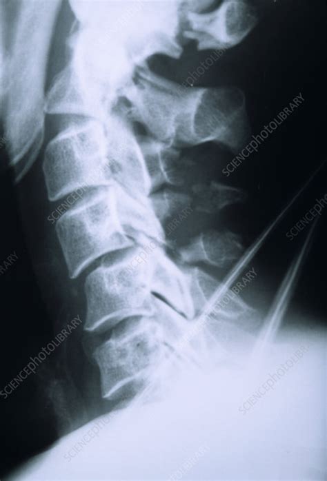 Broken neck, X-ray - Stock Image - M330/1077 - Science Photo Library