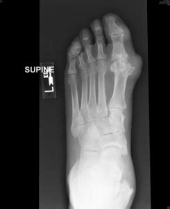 A Novel Treatment for Gout | Duke Health Referring Physicians