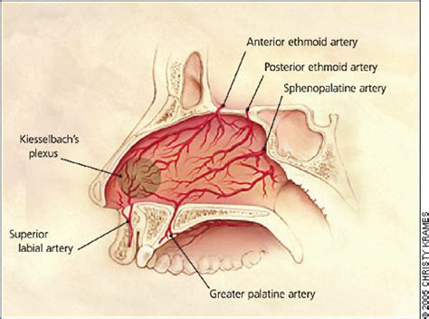 GPENT: Epistaxis