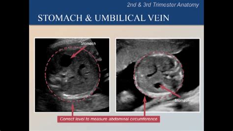 Fetal Umbilical Vein Ultrasound