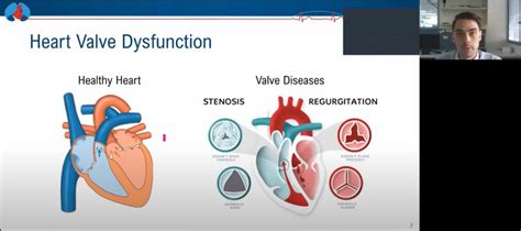 Improving the diagnosis of heart valve disease - Monash Partners