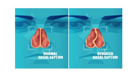 Septoplasty Before and After | My Story and Video