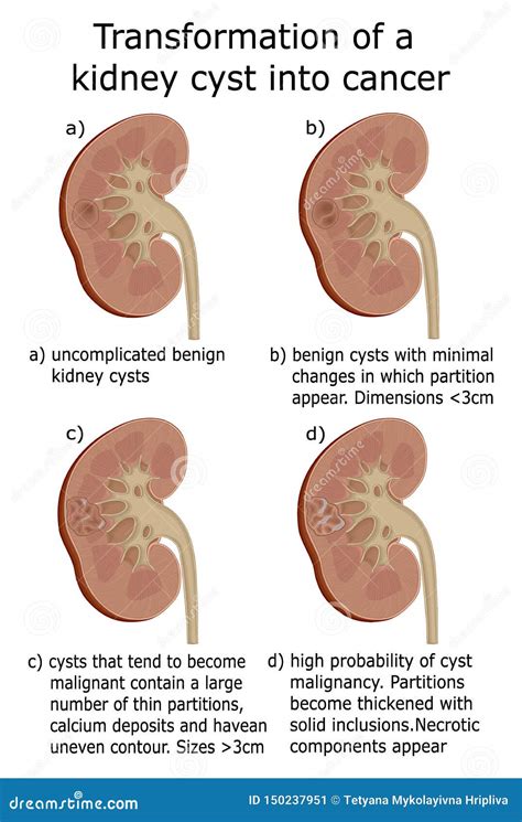 Illustration of Transformation of a Kidney Cyst into Cancer Stock Vector - Illustration of ...