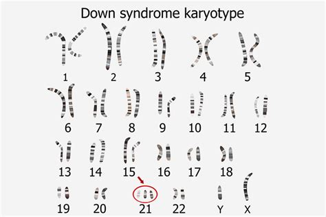 What Causes A Baby To Be Born With An Extra Chromosome? | MomJunction