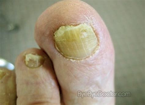 Fingernail Infection – Pictures, Symptoms, Treatment, Home Remedies | Symptoms Causes Treatment ...