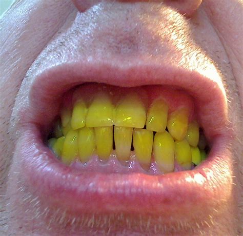 My Yellow Teeth Free Stock Photo - Public Domain Pictures
