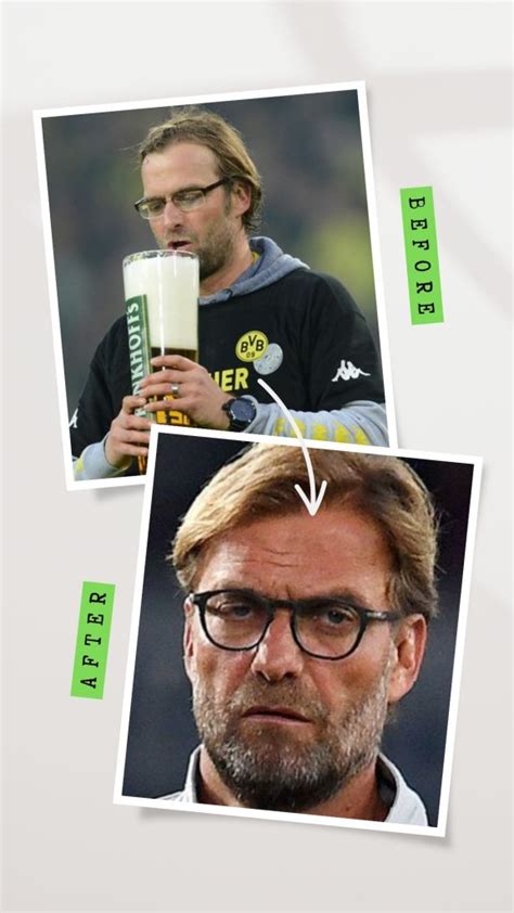 10 Incredibly Pictures Of Jurgen Klopp’s New Hair Transplant