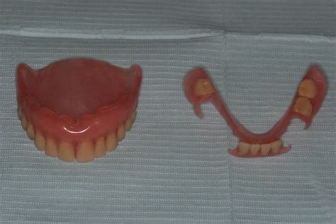 T-Crystal lower partial denture