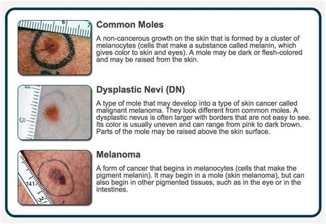 Dysplastic Nevus Raised