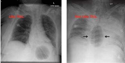 Sengstaken-Blakemore Tube Placement for Bleeding Esophageal Varices – Sinai EM