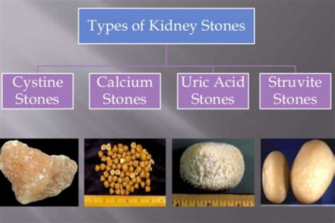 Kidney Stone Sizes Chart