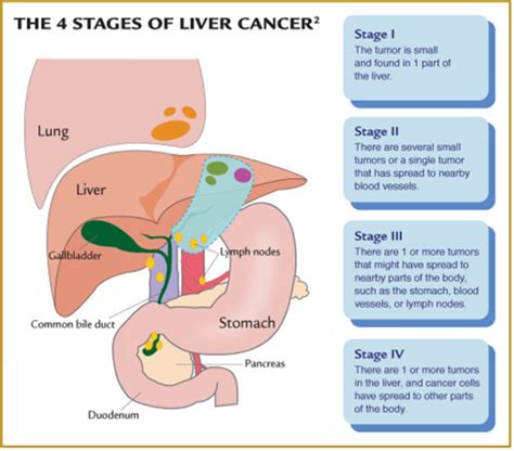 Liver Cancer Stages | Free Images at Clker.com - vector clip art online, royalty free & public ...