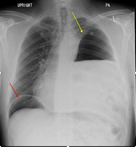 Chest x-ray showed a moderate left hemidiaphragm elevation with bowel... | Download Scientific ...