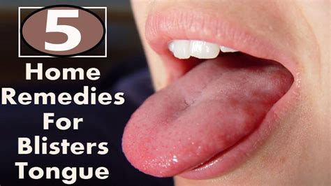 5 Home Remedies for Blisters on Tongue | By Top 5. - YouTube