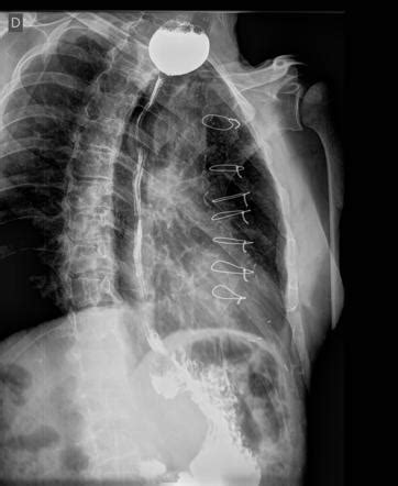 Esophageal diverticulum | Radiology Reference Article | Radiopaedia.org