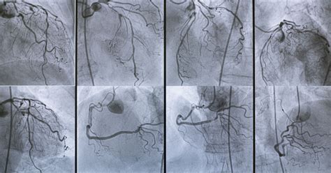 Coronary Angiography: Procedure, Side-Effects & FAQs