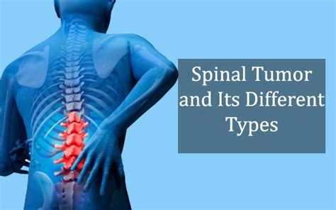 Spinal Tumors Types Causes Symptoms Treatment | The Best Porn Website