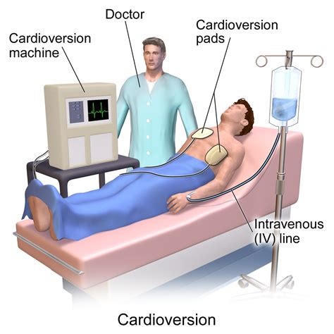 Cardioversion Explained - Central Georgia Heart Center