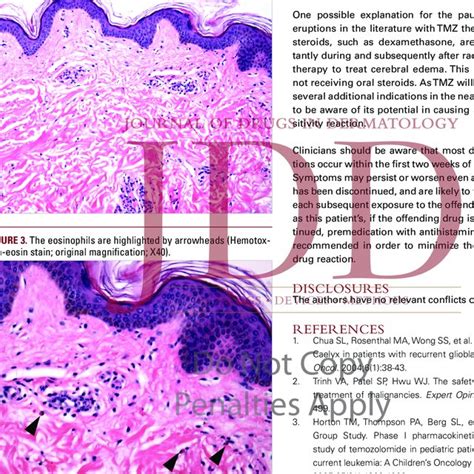 Mild papillary dermal edema and a perivascular and interstital... | Download Scientific Diagram