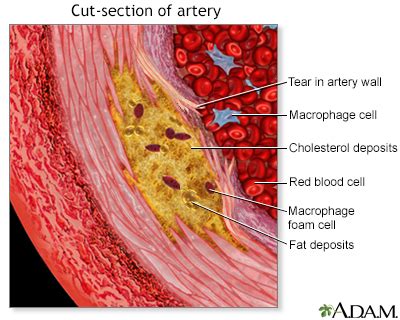 Hardening of the arteries Information | Mount Sinai - New York