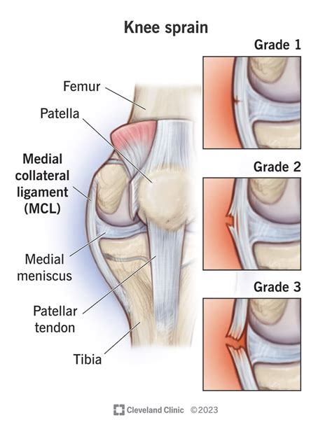 Pulled Knee Muscle Treatment