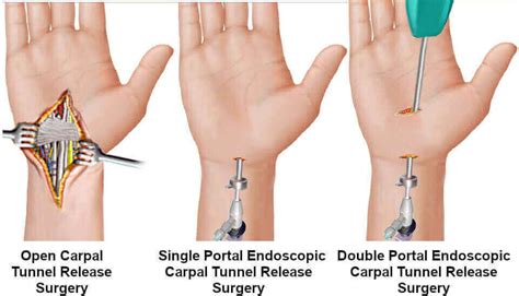 Pros & Cons of Endoscopic Surgery for Carpal Tunnel