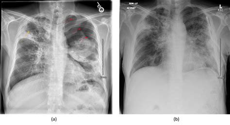 Incidental Spontaneous Pneumothorax in a Patient with Recently Diagnosed Tuberculosis ...