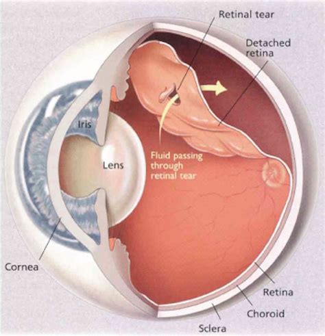 Treatment of Retinal Detachment | Review of Retinal Detachment