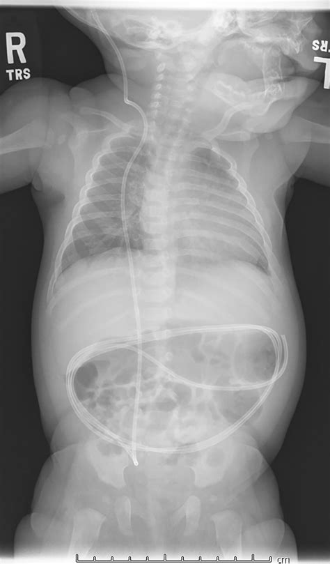 Don’t lose your head: Ventriculoperitoneal (VP) shunt issues | Radiology Key