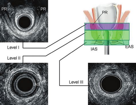 1 Normal ultrasonographic anatomy of the anal canal. EAS, external anal... | Download Scientific ...